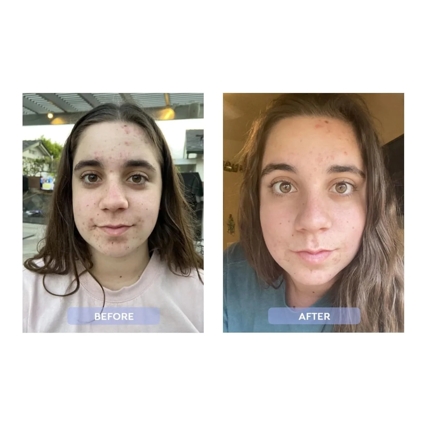 DR ZENOVIA Kit de acné de tez clara, tratamiento hormonal para el acné - Imagen 4